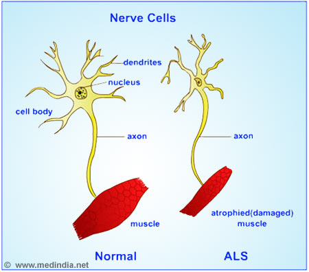 What is ALS