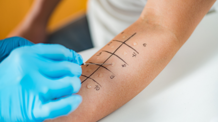4 Common Types of Allergy Tests and How to Prepare for Them