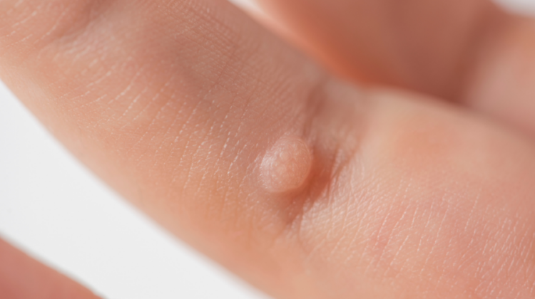 wart on finger