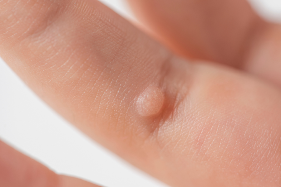 wart on finger