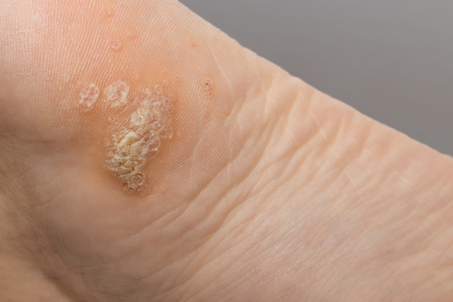 wart on foot