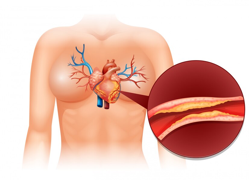 heart cholesterol arteries