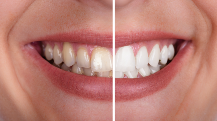 teeth whitening