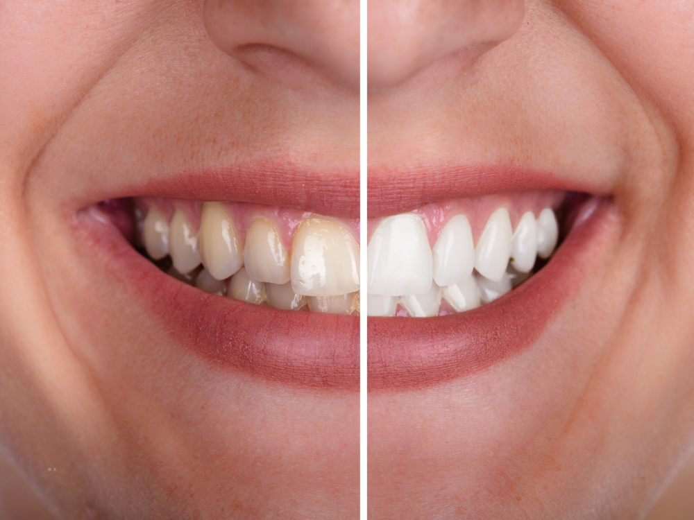 teeth whitening